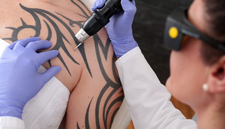 Laser Tattoo Removal vs. Cover Up: Which Should I Get?