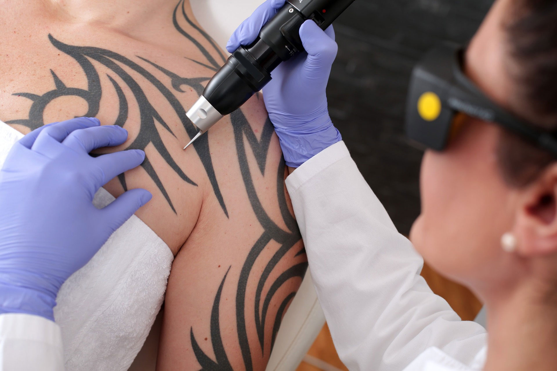 Laser Tattoo Removal vs. Cover Up: Which Should I Get?